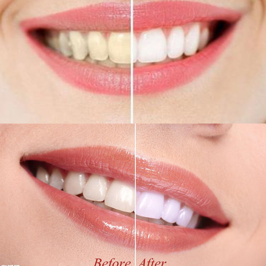 Dentes de carvão vegetal de ba - Teeth Whitening Zimba avaliação e preço