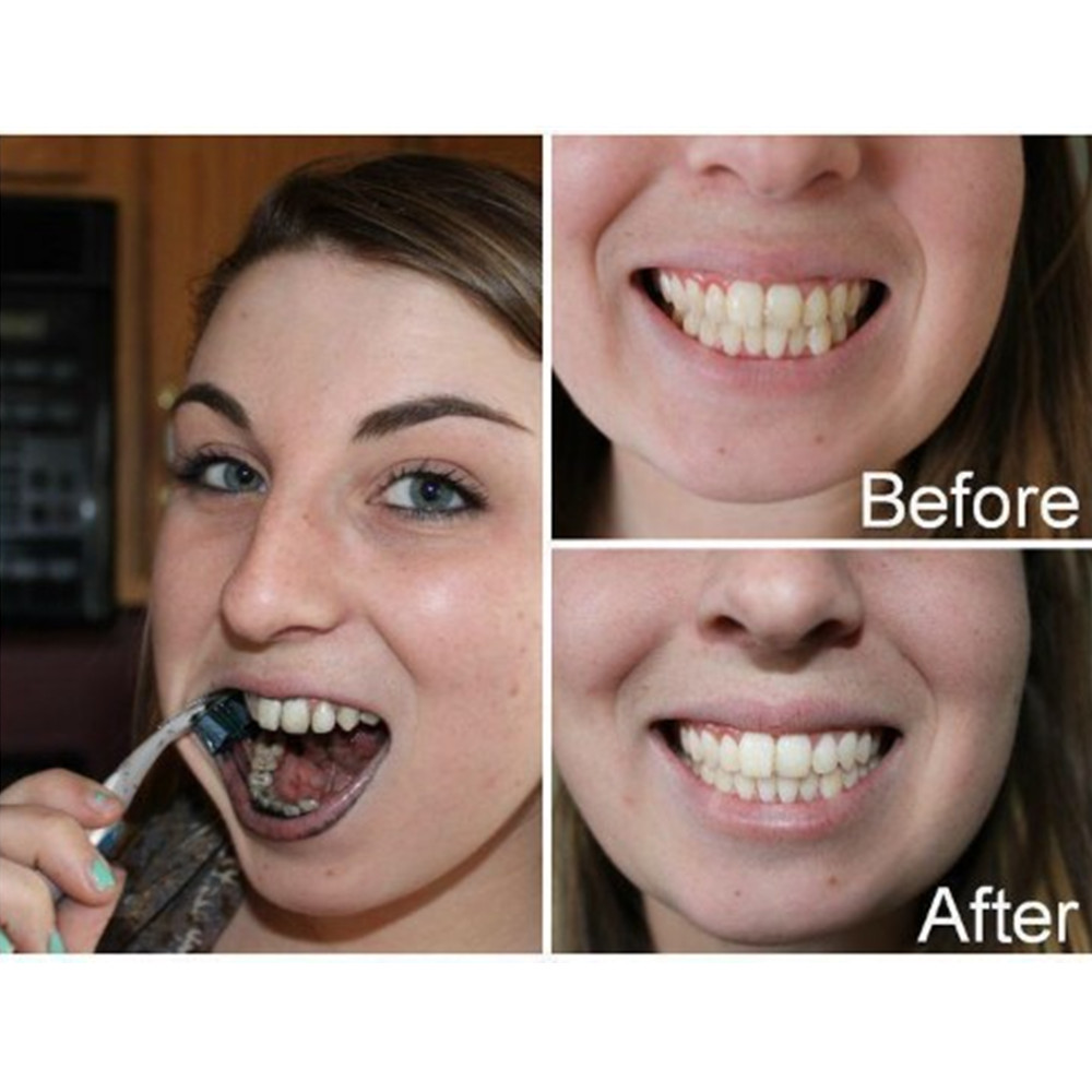 Dentes de carvão vegetal de ba - Teeth Whitening Zimba avaliação e preço
