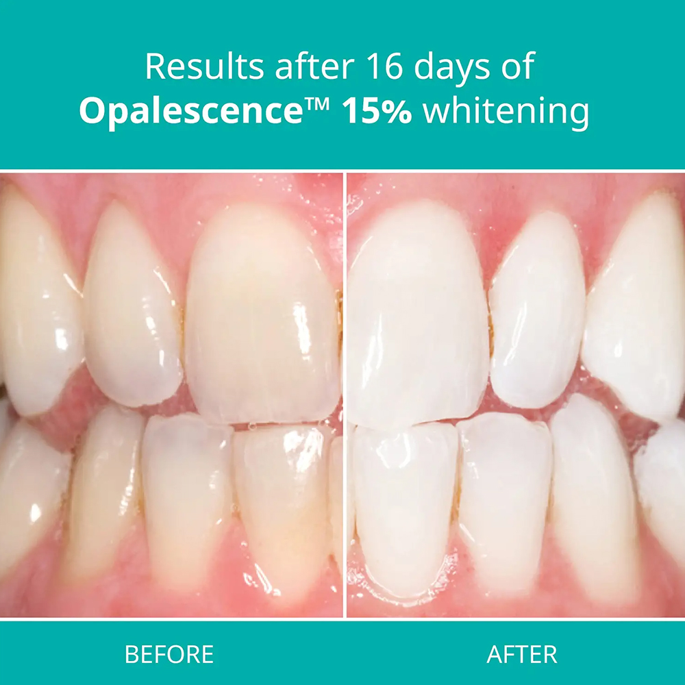 Kit de clareamento profissiona - Teeth Whitening Gel Opalescence avaliação e preço