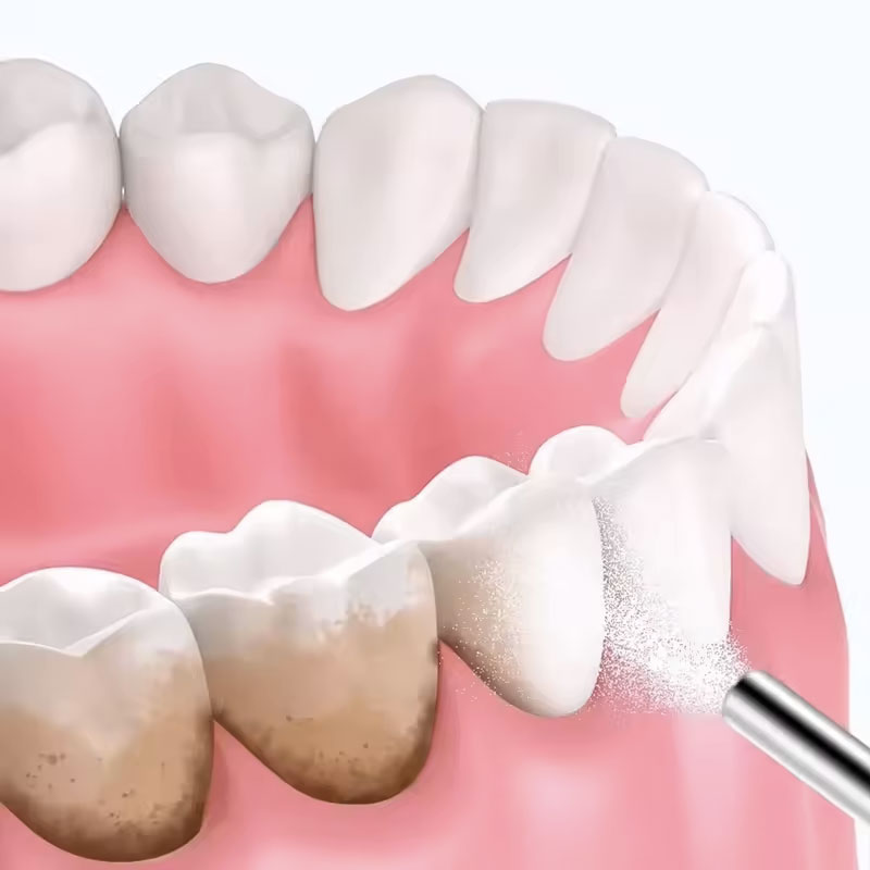 Pó para Jato de Areia Dental 1 - Teeth Whitening Zimba avaliação e preço