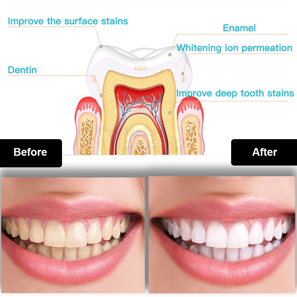 Kit de clareamento dental dos  - Teeth Whitening With Blue Light avaliação e preço